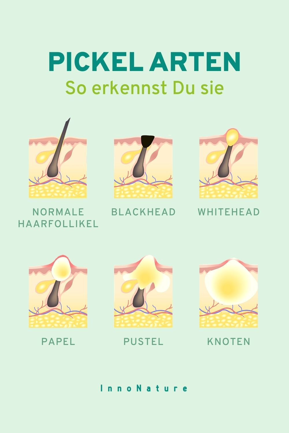 Infografik: Unterschiedliche Pickelarten